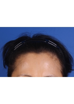 After Hair Transplant&nbsp;Hair Thinning